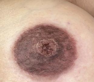 Unmittelbar nach der Behandlung 