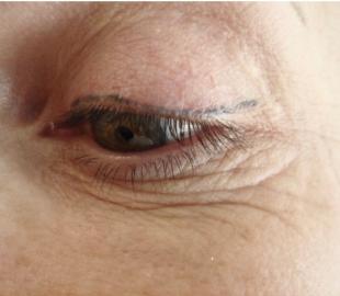 Vor der Korrekturbehandlung